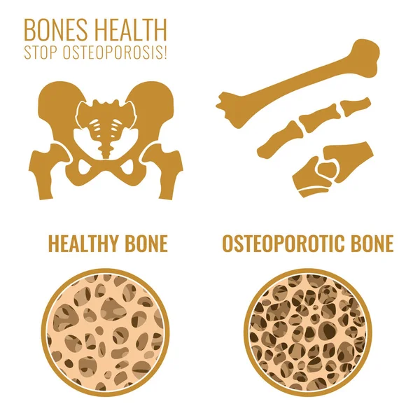 Стадии остеопороза — стоковый вектор