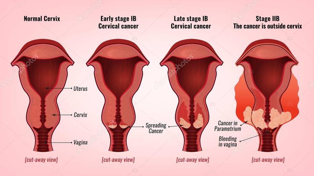 Imagen De C ncer De Cuello Uterino Vector De Stock Annyart 175973032 imagen-de-c-ncer-de-cuello-uterino-vector-de-stock-annyart-175973032