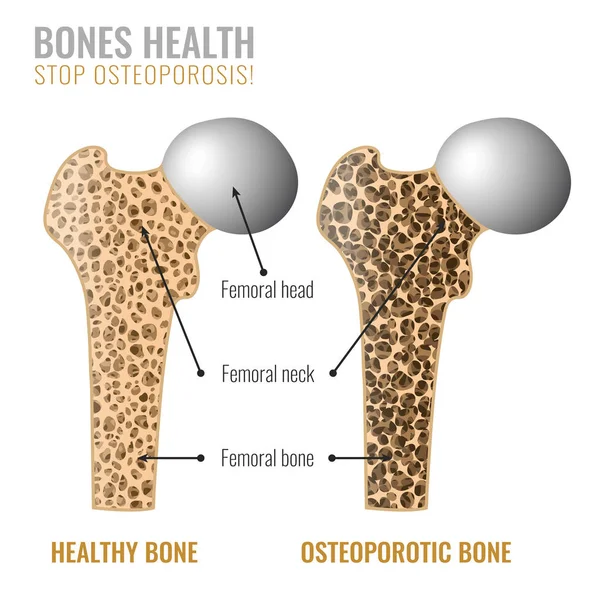 Knochenbild der Osteoporose — Stockvektor