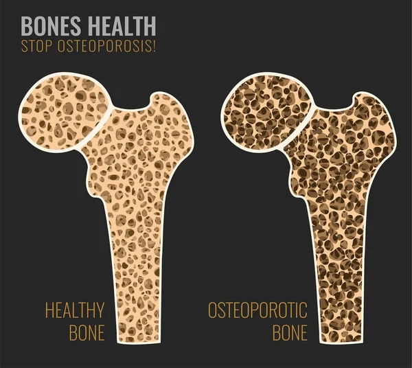 Knochenbild der Osteoporose — Stockvektor