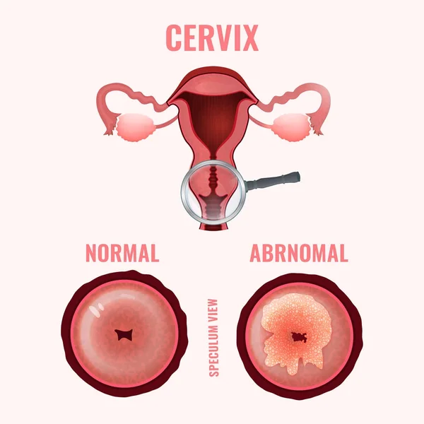 Imagen del cáncer cervical — Vector de stock