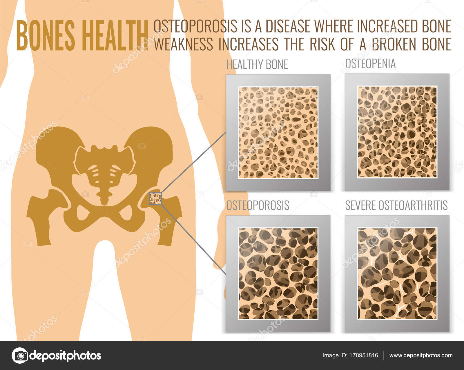 Osteoporosis Bones Poster Stock Vector by ©annyart 178951816