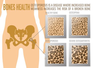 Osteoporosis Bones Poster clipart