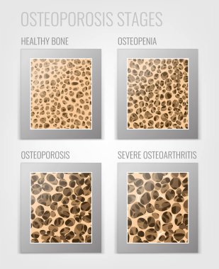 Osteoporosis Stages Image clipart