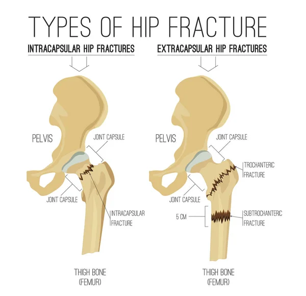 Tipos de fractura de cadera — Archivo Imágenes Vectoriales