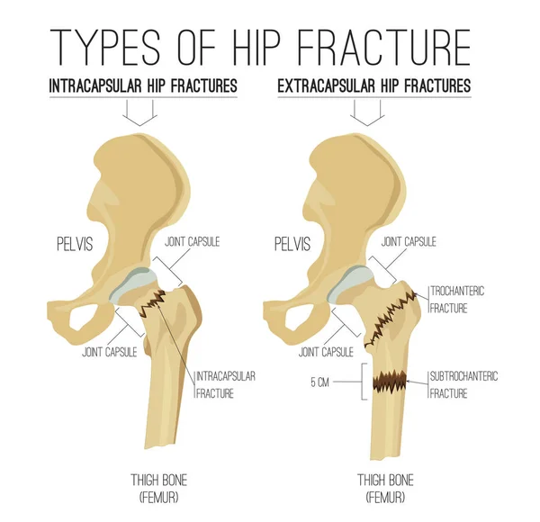 100 000 fracture de la hanche vector images depositphotos