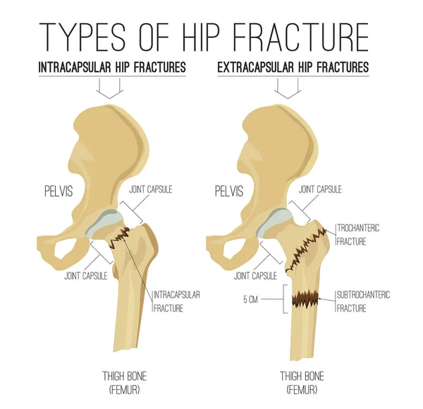Arten von Hüftfrakturen — Stockvektor