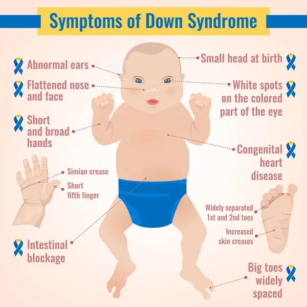 Symptômes du syndrome de Down — Image vectorielle