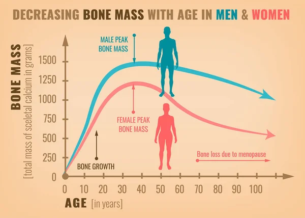 Reducción de la masa ósea — Vector de stock