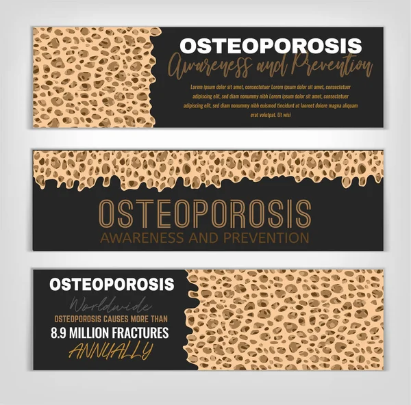 Osteoporosis Banners Set — Stock Illustration Osteoporosis Banners Set Vector Graphics