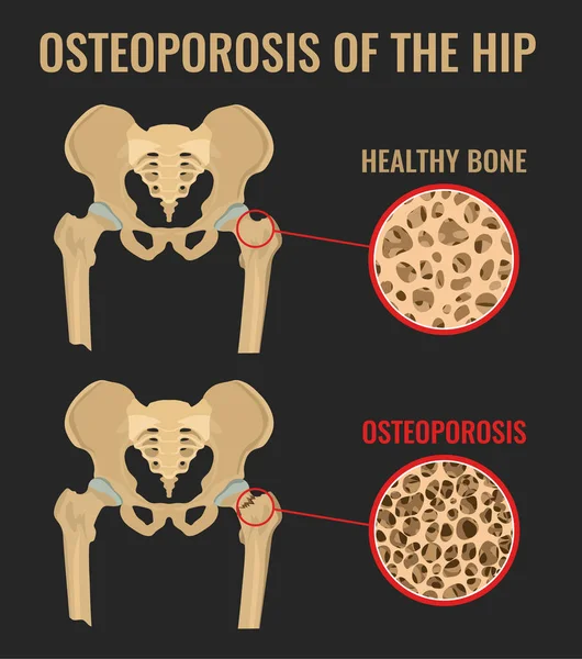 Osteoporose do quadril — Vetor de Stock