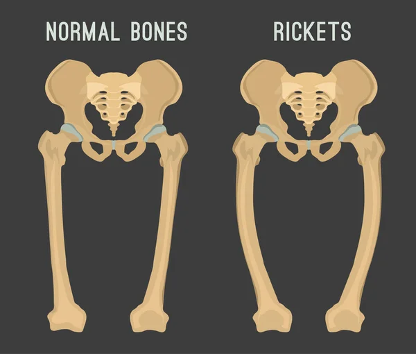 Schéma de Rickets vectoriels — Image vectorielle