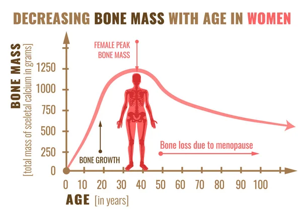 Уменьшение массы костей — стоковый вектор