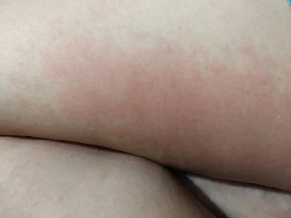 Eruzione Cutanea Rossa Reazioni Cutanee Sulla Pelle Della Gamba Delle — Foto Stock