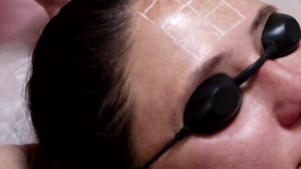 Uma Mulher Está Preparando Para Procedimento Rejuvenescimento Laser Salão Cosmetologista — Vídeo de Stock