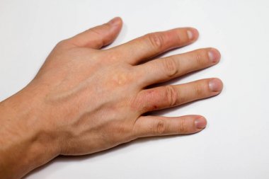 El dermatit. El Egzamasi