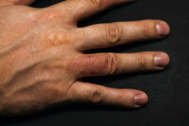 El dermatit. El Egzamasi