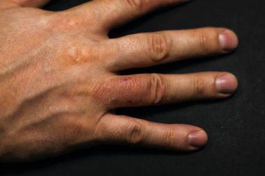 Hand dermatitis. Hand eczema clipart