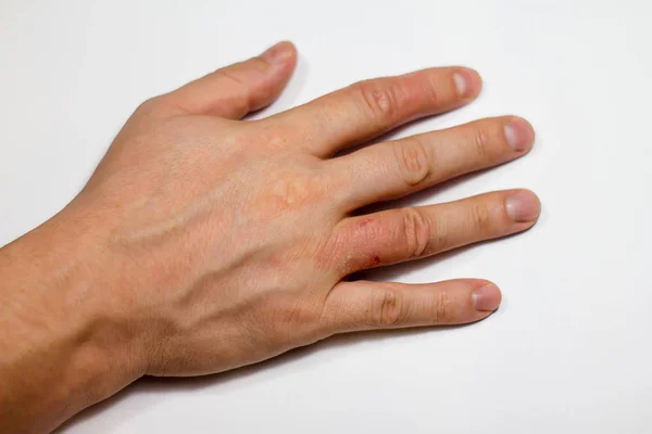 El dermatit. El Egzamasi