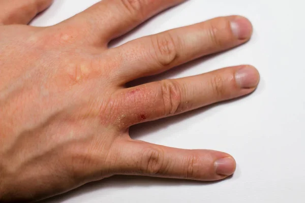 Hand dermatit. Handeksem — Stockfoto