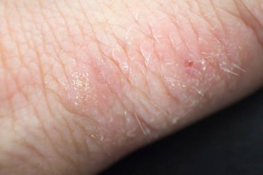 El dermatit. El Egzamasi