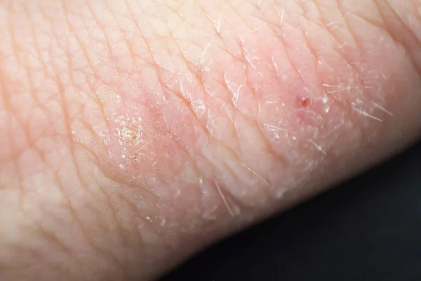 Dermatite das mãos. eczema da mão — Fotografia de Stock