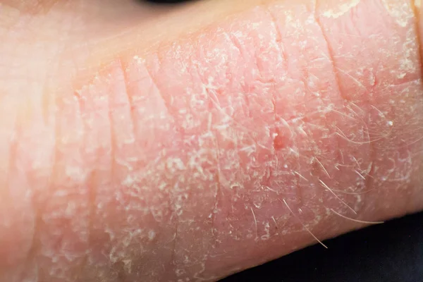 Dermatite das mãos. eczema da mão — Fotografia de Stock