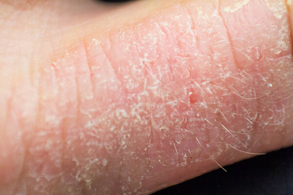 Hand dermatitis. Hand eczema
