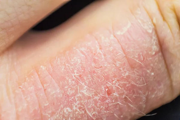 Dermatitis tangan. eksim tangan — Stok Foto