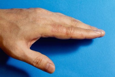 Hand dermatitis. Hand eczema clipart