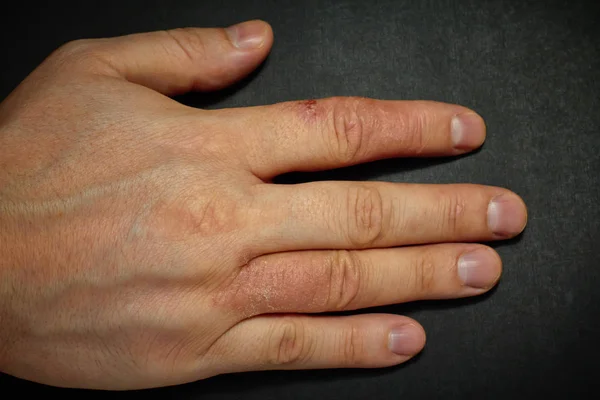 Hand dermatitis. Hand eczeem — Stockfoto