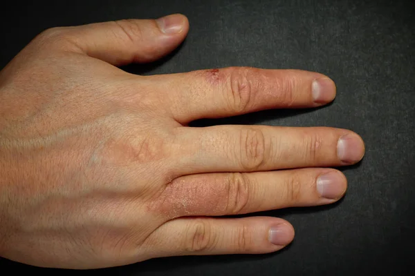 Hand dermatitis. Hand eczema — Stock Photo, Image