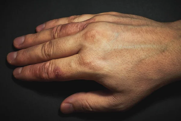 Ручний дерматит. Екзема рук — стокове фото