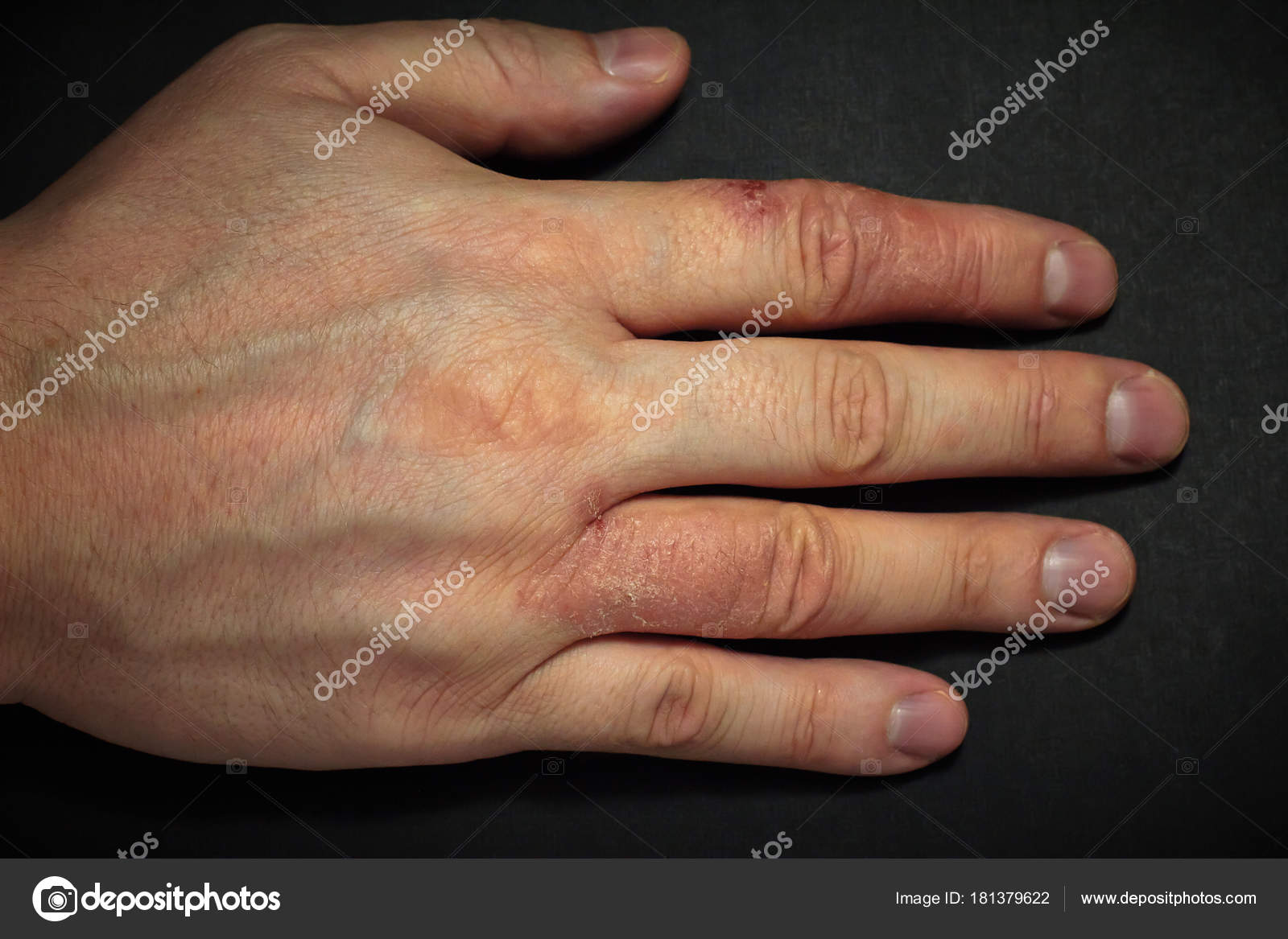 Fingertip Eczema