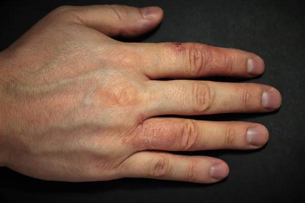 Hand dermatitis. Hand eczema — Stock Photo, Image