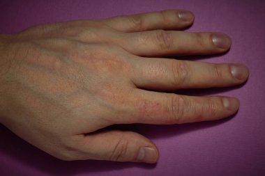 El dermatit. El Egzamasi