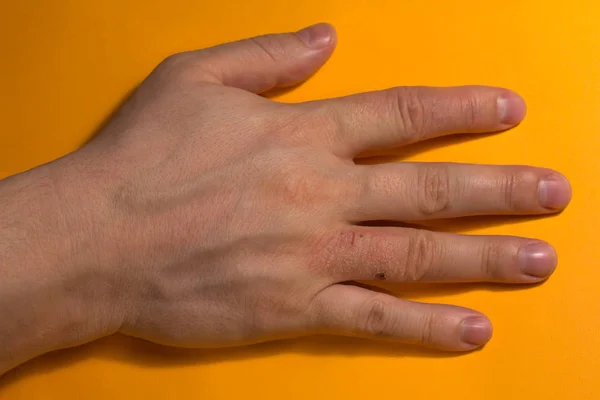 Dermatite das mãos. eczema da mão — Fotografia de Stock
