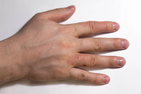 Hand dermatit. Handeksem — Stockfoto