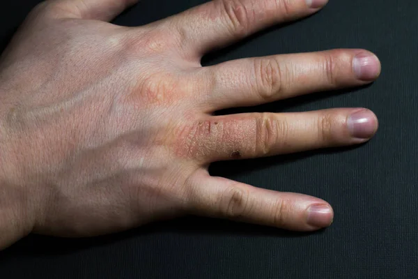 Dermatite das mãos. eczema da mão — Fotografia de Stock