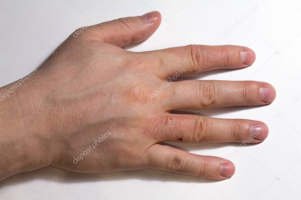 Hand dermatitis. Hand eczema — Stock Photo © d19p76 190624238