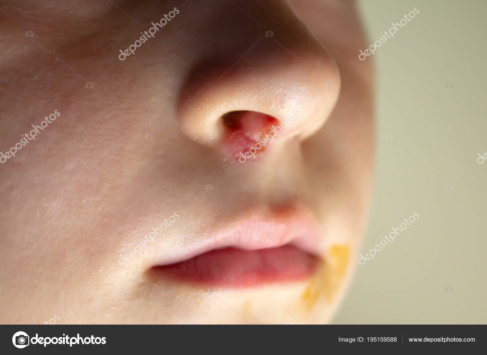 Herpes In Der Nase Ziemlich Kaukasischem Junge Mit Herpes Nase Auf