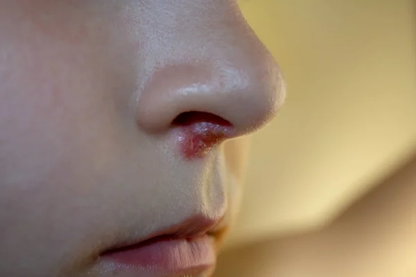 Herpes on the nose - Pretty young caucasian boy with herpes her on nose. Close-up. Human Virus — Stock Photo, Image