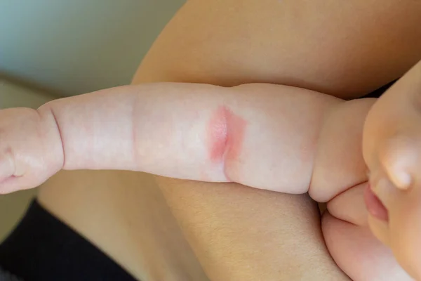 Prickly heat. Close-up of the folds of the hand of a newborn baby with red skin. — Stock Photo, Image