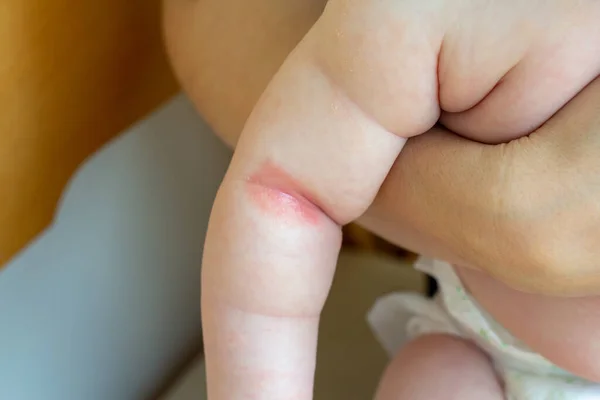 Stekelige hitte. Close-up van de plooien van de hand van een pasgeboren baby met rode huid. — Stockfoto