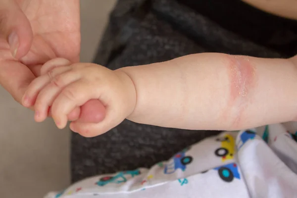 Calor espinoso. Primer plano de los pliegues de la mano de un bebé recién nacido con piel roja . — Foto de Stock