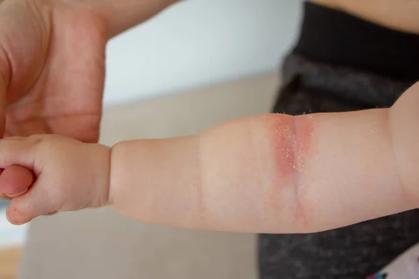 Prickly heat. Close-up of the folds of the hand of a newborn baby with red skin. — Stock Photo, Image