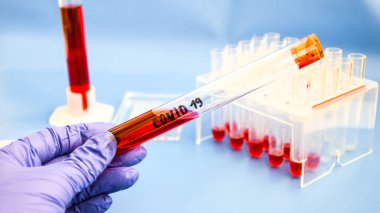 Coronavirus Kan Numunesi, laboratuvar ve kan örneği toplama tüplerindeki kanın DNA testi ve DNA modern arayüzlü şırınga, covid-19 virüsü.