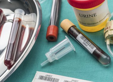 İdrar ve kan örnekleri kavramsal görüntü bir hastane masada