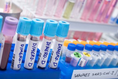 Sars-Cov-2 'den yüksek oranda dimero-D içeren kan örnekleri bir laboratuvar, kavramsal görüntüde enfekte olmuş hastalar