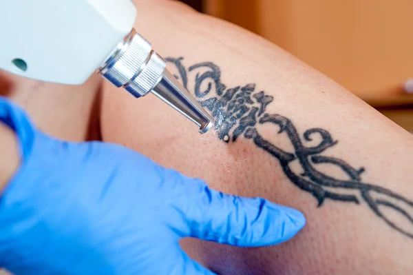 Remoção de tatuagem, corpo, perna , — Fotografia de Stock